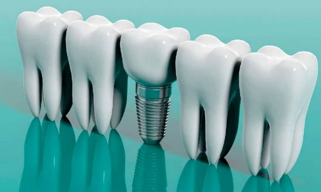 Владимир Лосев рассказал о главных мифах про установку зубных имплантатов
